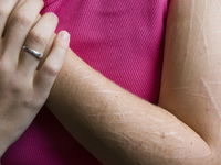 Zelfbeschadiging onder jongeren: 'We moeten niet veroordeeld worden'