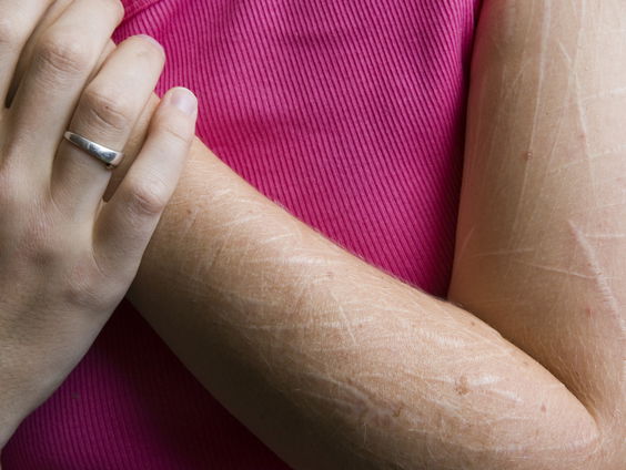 Zelfbeschadiging onder jongeren: 'We moeten niet veroordeeld worden'