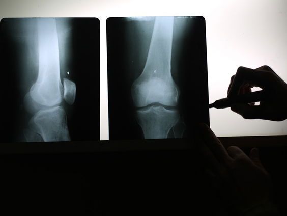 Chinese artsen ontwikkelen bottenlijm: breuk na drie minuten geheeld