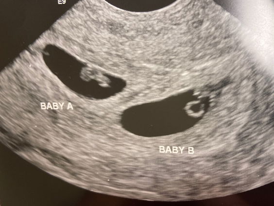 Gezonde baby geboren uit een meer dan 30 jaar geleden bevroren embryo