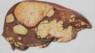 Leververvetting is stille epidemie
