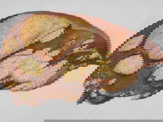 Leververvetting is stille epidemie