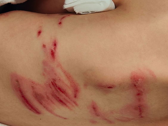 Weer een kind gebeten in wolvengebied Utrecht