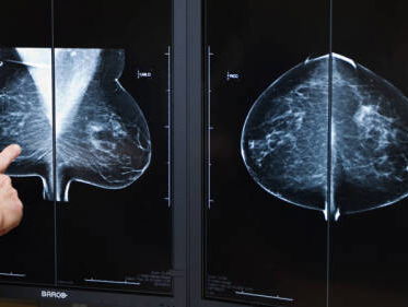 Relatie alcohol en borstkanker onderbelicht