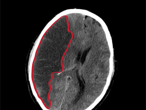 Hoe hersenschade na een beroerte kan worden beperkt