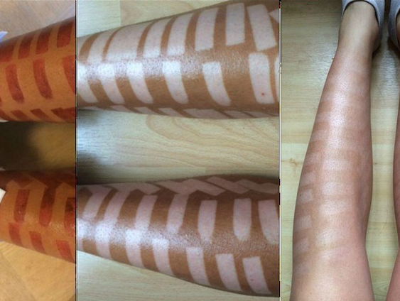 Brandwonden door ontharingsbehandeling: 'Denk goed na voordat je een goedkope behandeling boekt'