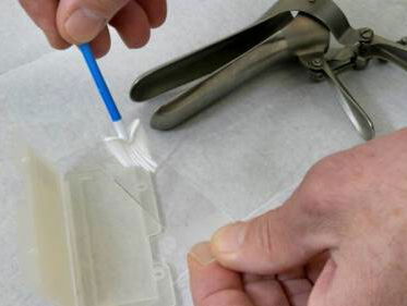 Nieuwe voorlichtingscampagne voor bevolkingsonderzoek naar baarmoederhalskanker