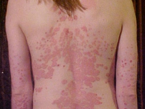 De biologie achter Kim Kardashian haar psoriasis