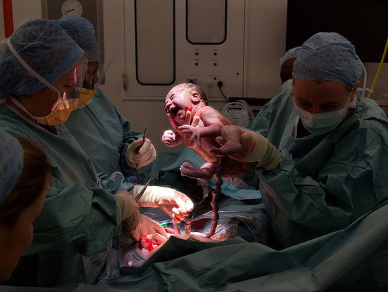 Door moeder begeleide keizersnede steeds meer uitgevoerd