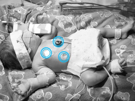 Een draadloze monitor voor premature baby's