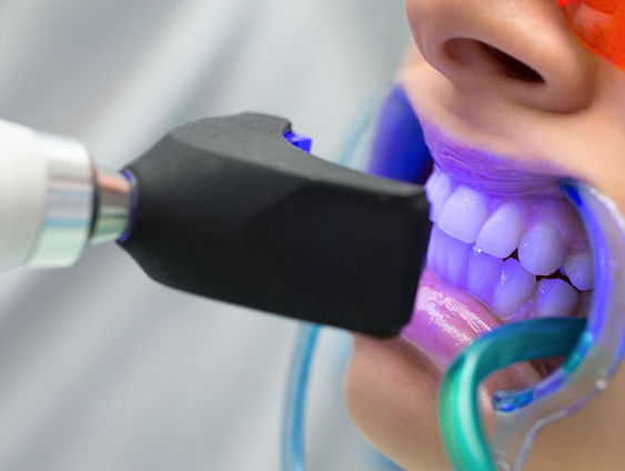 Tanden bleken: ‘Blauw licht ziet er indrukwekkend uit, maar het heeft geen zin’