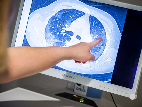 Coronavirus veroorzaakt meer dan alleen longontstekingen