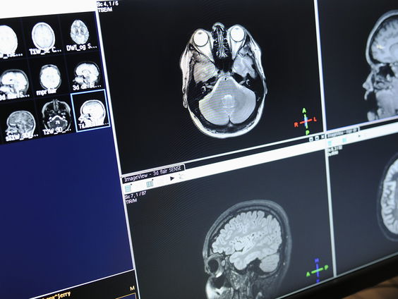 Na een hersenschudding nog jaren last: Eva Krook ging naar de VS om beter te worden