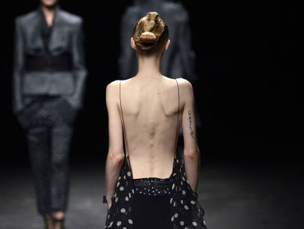 'Praat niet over, maar praat mét anorexiapatiënten'