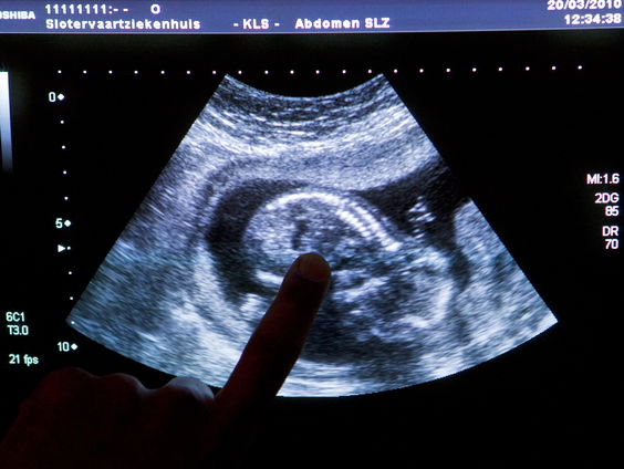 Moeten familieleden van iemand met een erfelijke ziekte meer geïnformeerd worden?