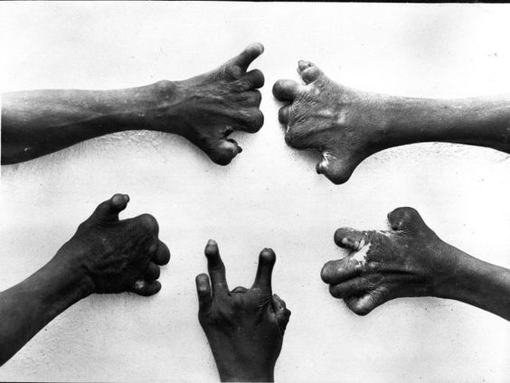 Wat kan lepra ons leren over pandemieën ?