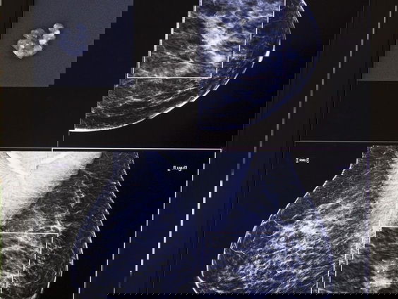 LUMC eerste ziekenhuis in Nederland met pijnvrij borstonderzoek