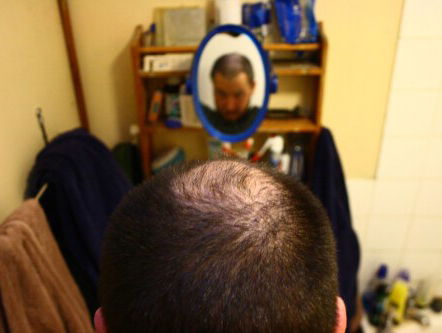 Waarom worden mannen al-tijd kaal op dezelfde plek?