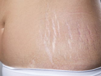 Dokter Felicia over 'striae'