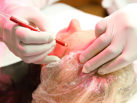 Jeugd veel vaker aan de botox, effect soms desastreus