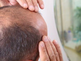 Raymon Hilkman heeft een tragikomische film gemaakt over vroegkalende mannen: 'De Overkammer'