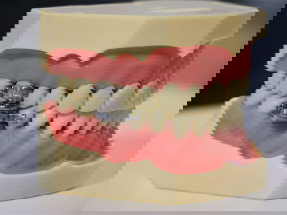 Afvallen? Neem een kaakklem!