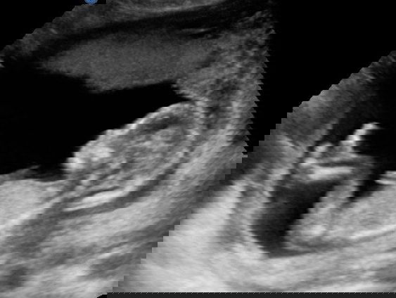 Van Nu Naar Toen: Het begin van de zwangerschapsecho’s