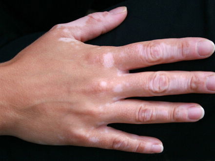 Het is wereld vitiligo dag