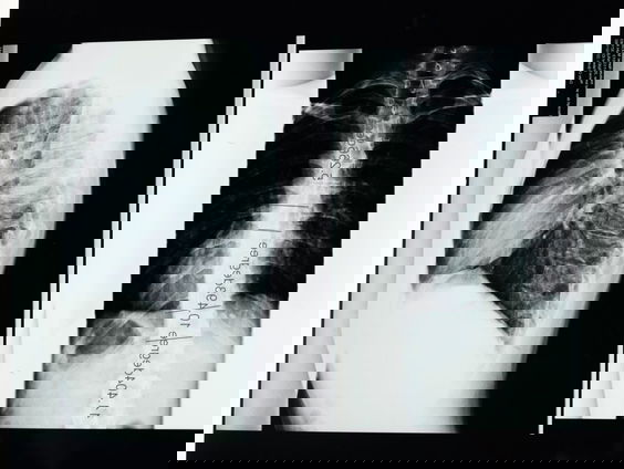 Lina heeft een heftige vorm van scoliose en Mourid probeert haar te helpen!