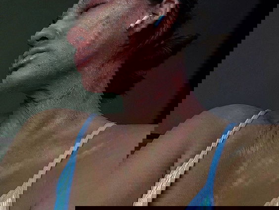 Cansu (23) heeft een huidaandoening: "Het lijkt op eczeem, maar de symptomen zijn anders"