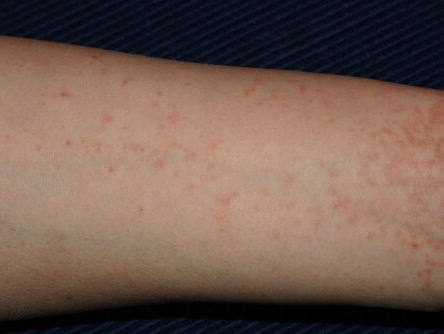 Steeds meer schurft in studentenhuizen