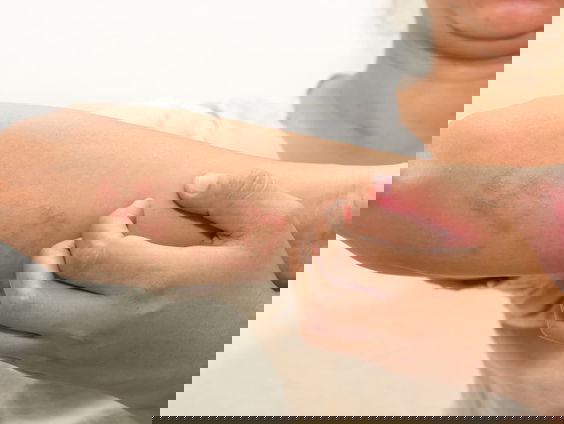 400.000 Nederlanders hebben last van eczeem. Is dit de behandeling van de toekomst?