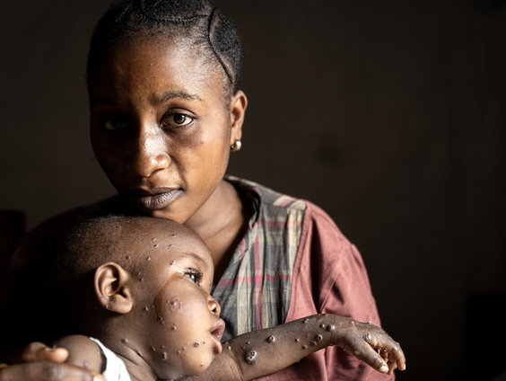 Eerste mensen worden tegen mpox gevaccineerd in Congo