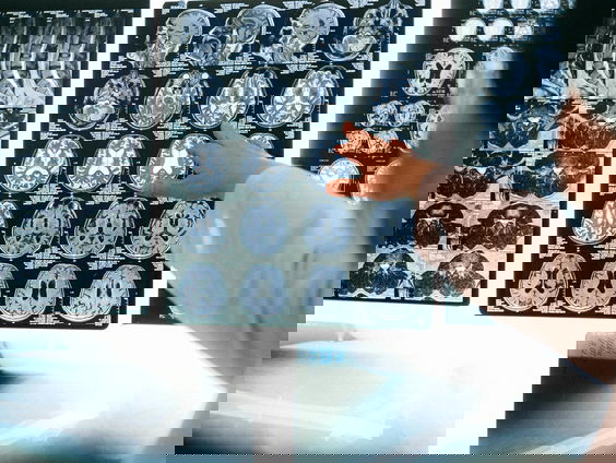 AI wordt steeds belangrijker in de radiologie, maar zal nooit een radioloog vervangen