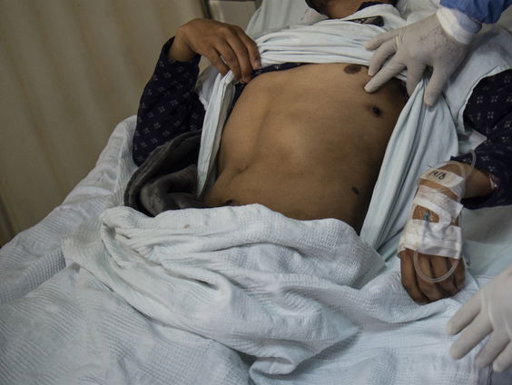 De zorgelijke situatie in Oost-Congo na een nieuwe mpox-uitbraak