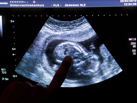 Ziekenhuizen doen proef met late abortussen tussen 22 en 24 weken
