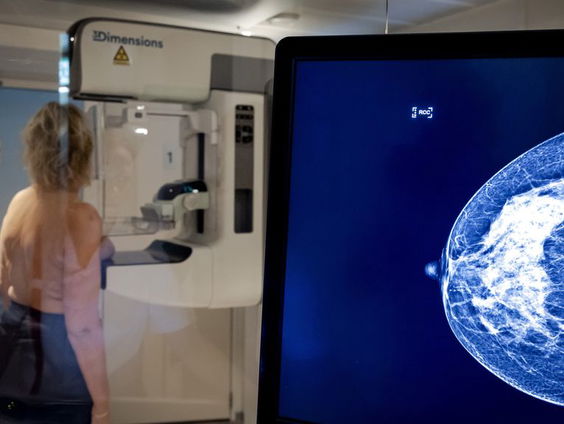 Extra MRI-scan voor vrouwen met dik borstweefsel mogelijk vanaf 2030