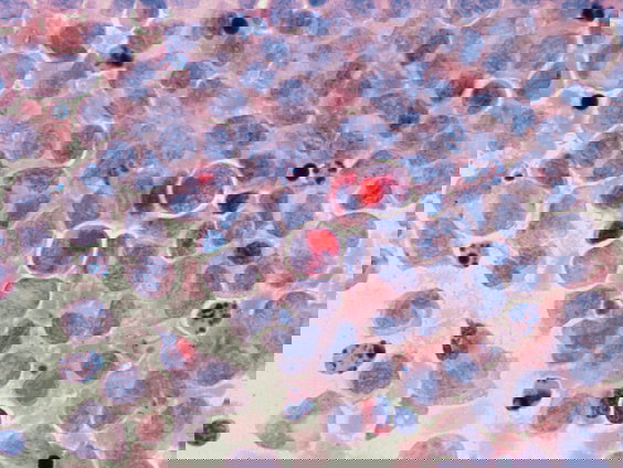 Mythe ontkracht: Stress zorgt niet voor kanker