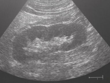 Nierstichting: nierschade is een onderbelicht probleem