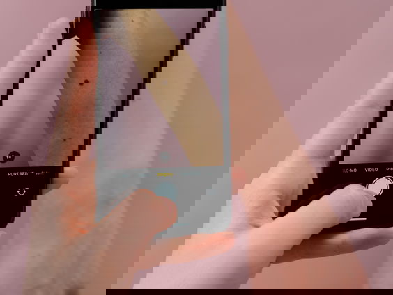 Wanneer is een moedervlek gevaarlijk?