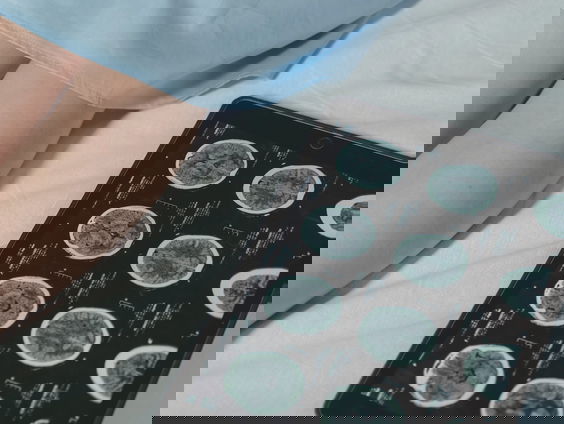 Nieuwe immuuntherapie tegen huidkanker wordt straks vergoed