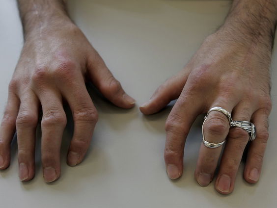 Goed nieuws voor artrosepatiënten: Eeuwenoud medicijn lijkt te werken tegen artrose