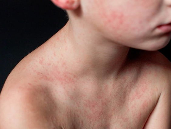 Steeds meer mazelen in Europa: moet Nederland zich zorgen maken?