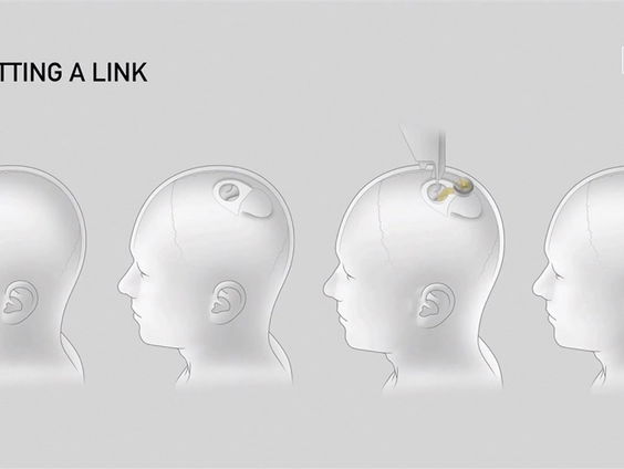 Hersenimplantaat van Elon Musk kan potje schaken