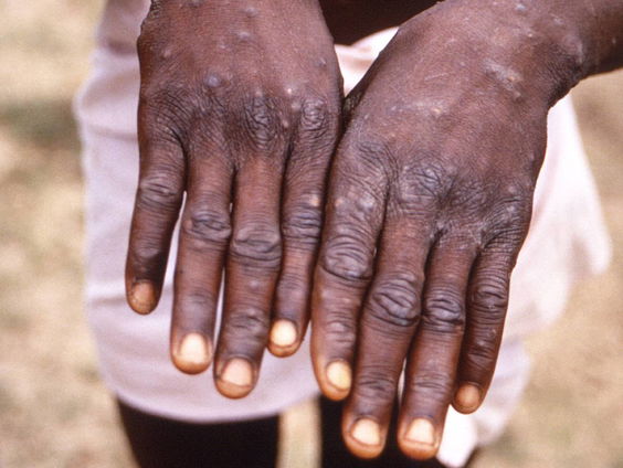 Eerste besmetting met het apenpokkenvirus in Nederland