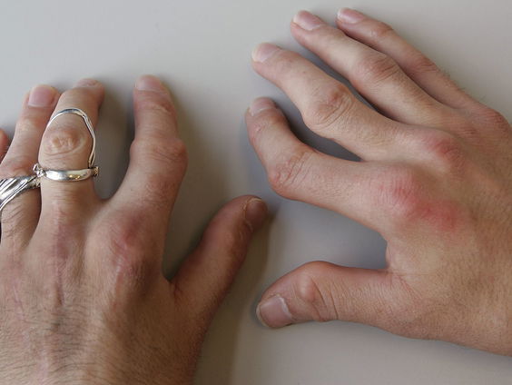 Artrose en reuma bestrijden