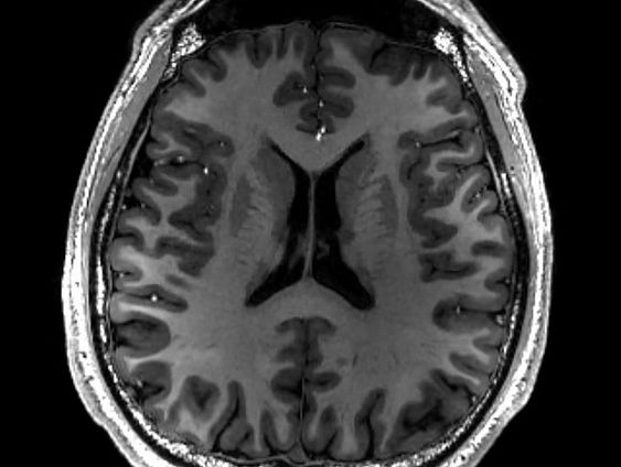 Het zieke brein ontrafeld in de MRI-scanner