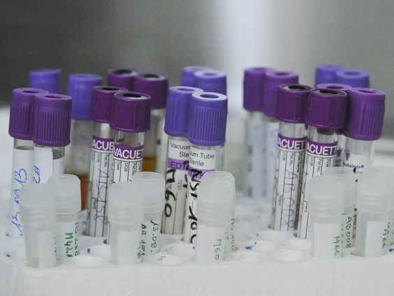 Extra besmettelijke hiv-variant ontdekt in Nederland